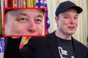 Sağ gözü neden mor? Elon Musk sebebini açıkladı